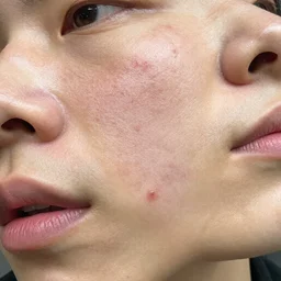 judicious hooker’s heat pimples